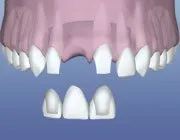 Dental Bridge