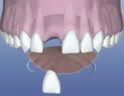 a dental implant flipper