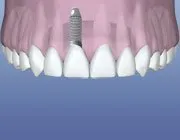 Dental Implant