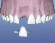 Missing Tooth