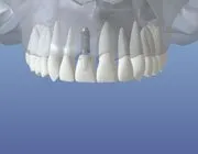 implant restored