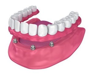 Illustration showing Implant Supported Overdenture for the bottom jaw