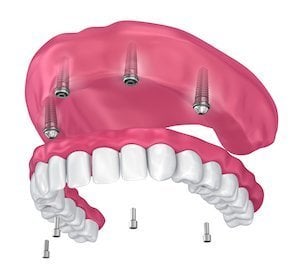 Illustration showing Implant Supported Overdenture for the top jaw